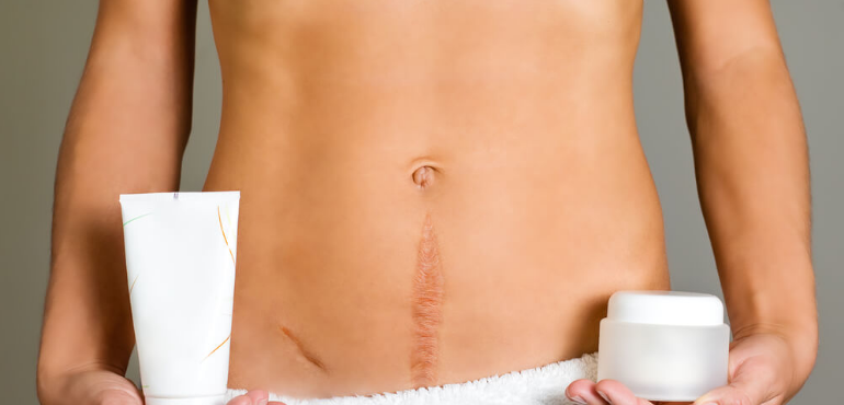 Cirurgia plástica para cicatrizes: Conheça o procedimento