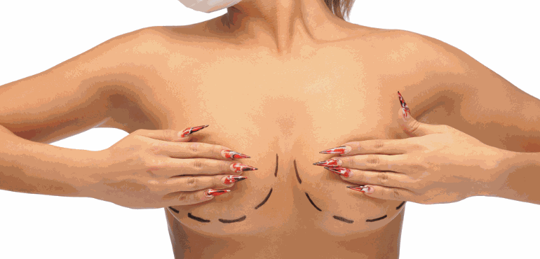 Mastopexia e redução de mamas: saiba as diferenças