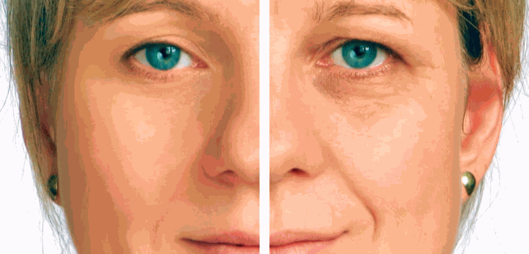 Ritidoplastia ou Lifting facial  : entenda o procedimento