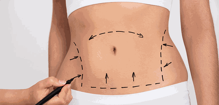 Saiba mais sobre o procedimento de abdominoplastia