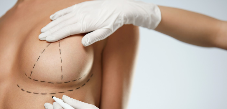 Mastopexia: Cirurgia plástica para levantamento das mamas